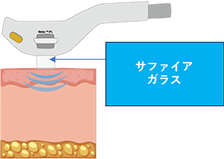 痛みの少ないフォトフェイシャル